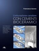 Otturazione Canalare con i Cementi Bioceramici Otturazione Canalare con i Cementi Bioceramici